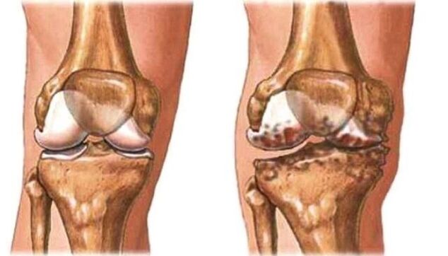 Kniearthrose und gesundes Knie