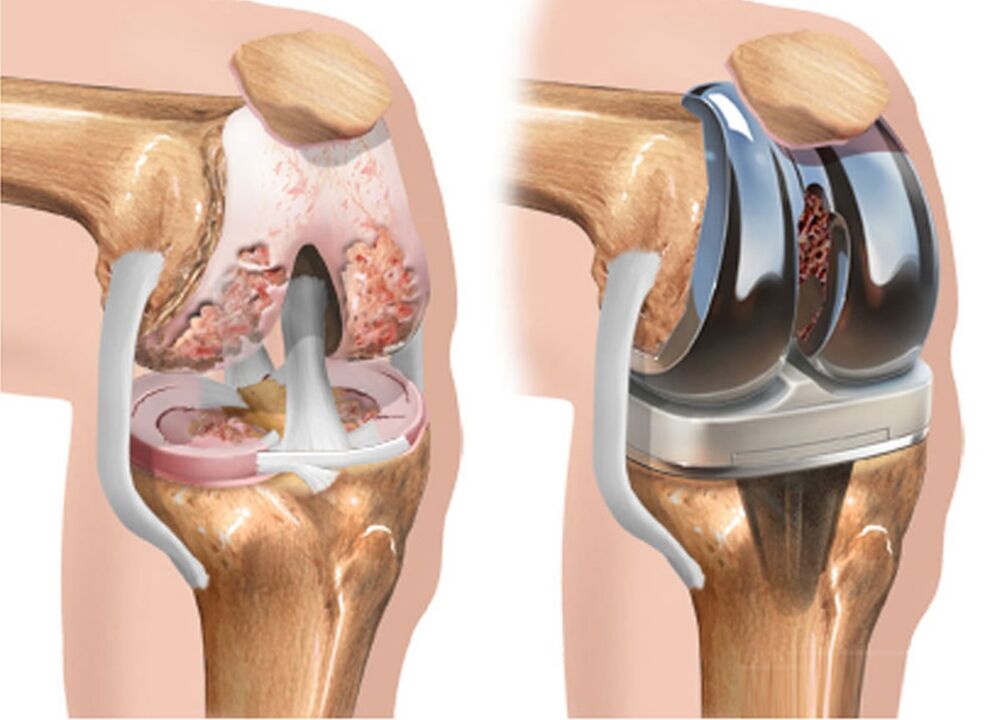 vor und nach Arthrose des Kniegelenks aufgrund von Arthrose