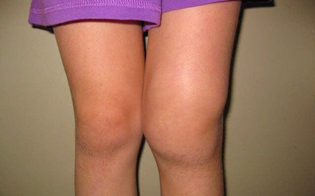 geschwollenes Kniegelenk aufgrund von Arthrose