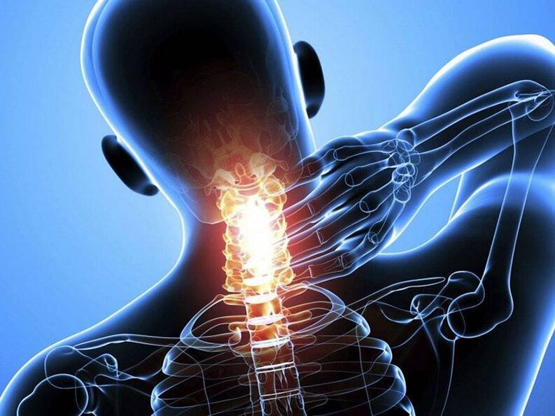 Osteochondrose der Halswirbelsäule wird von Nackenschmerzen begleitet. 
