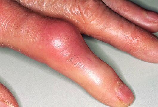 Gicht wird von akuten Schmerzen in den Fingern und Schwellungen der Gelenke begleitet. 