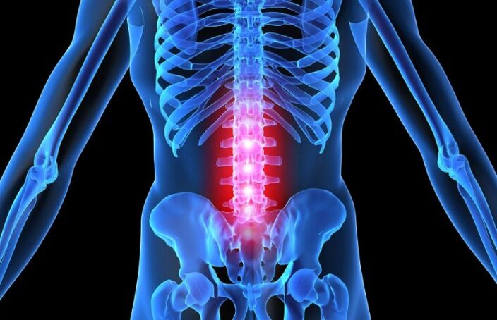 Osteochondrose der Lumbalregion