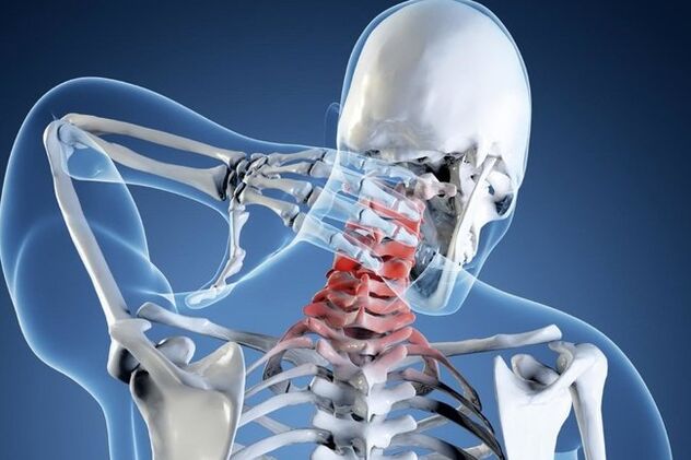 Osteochondrose der Halswirbelsäule